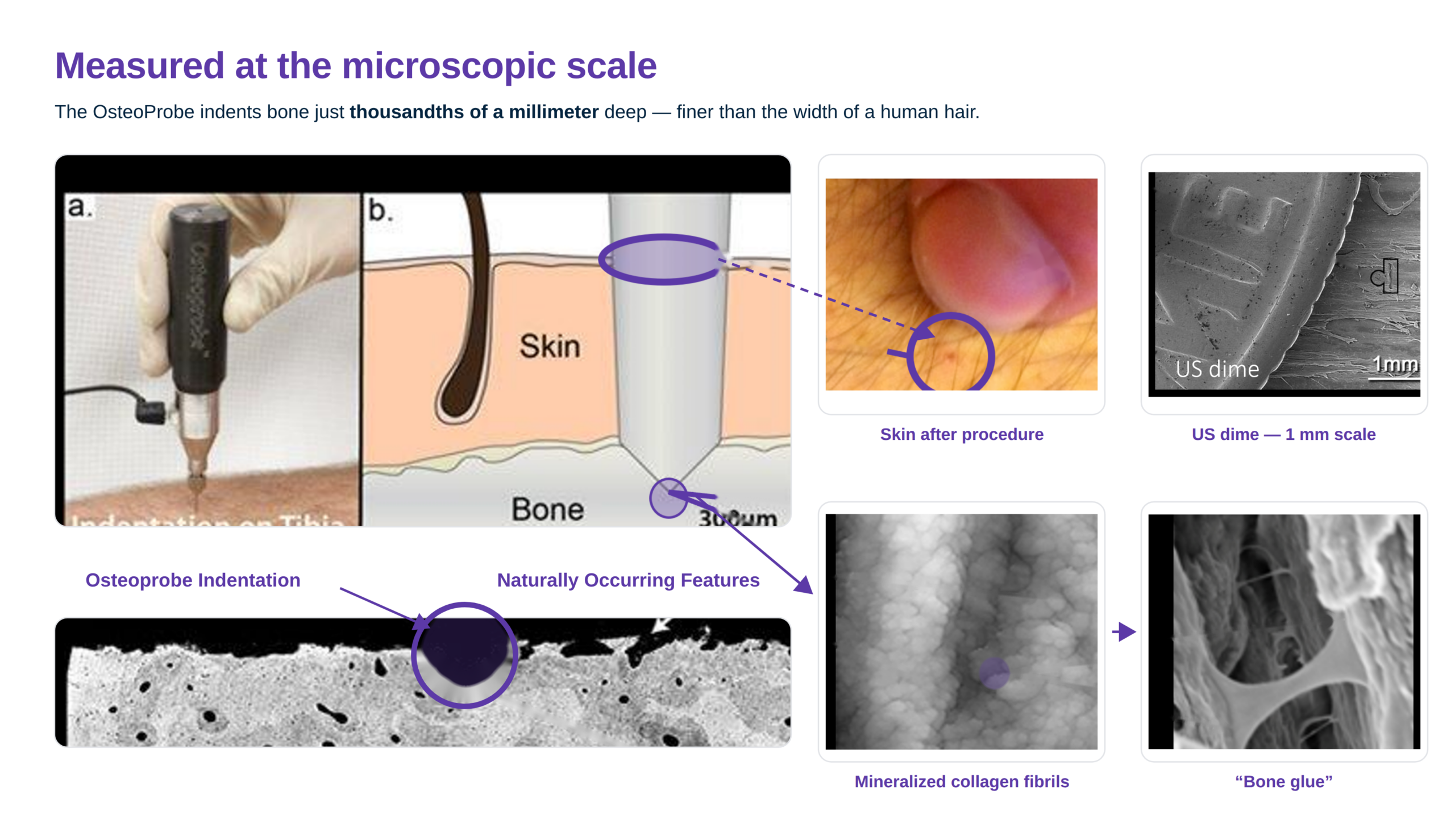 OsteoProbe indentation at microscopic scale: indentation on the tibia, mineralized collagen fibrils, bone glue, a US dime for scale, and skin after the procedure